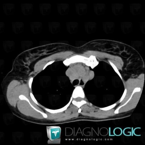 Sarcoidosis, Mediastinum, CT