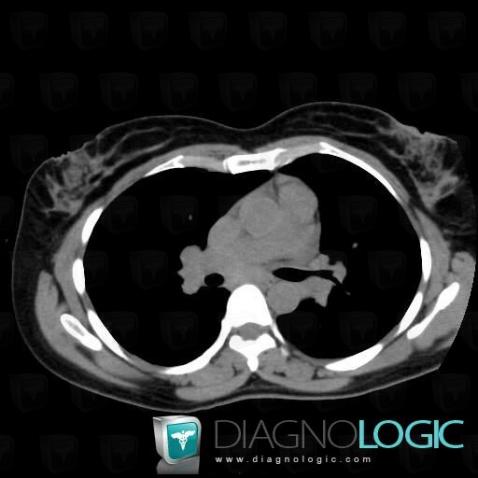 Sarcoidosis, Mediastinum, CT