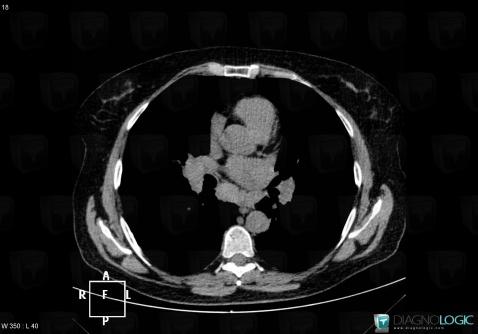 Sarcoidosis, Mediastinum, CT