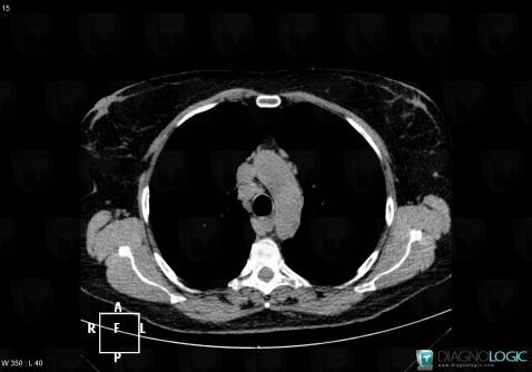 Sarcoidosis, Mediastinum, CT