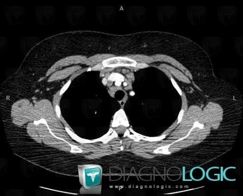 Sarcoidosis, Mediastinum, CT