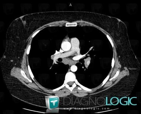 Sarcoidosis, Mediastinum, CT