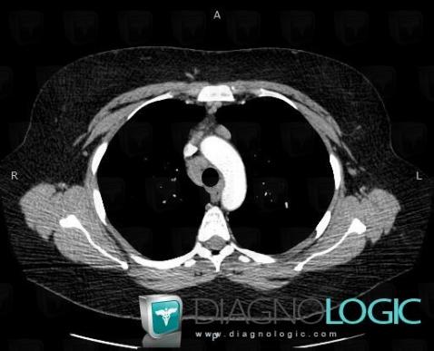 Sarcoidosis, Mediastinum, CT