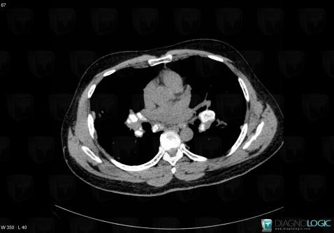 Sarcoidosis, Mediastinum, CT