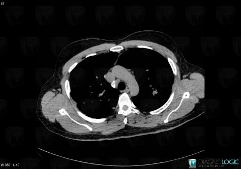 Sarcoidosis, Mediastinum, CT