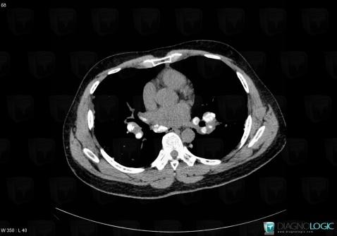 Sarcoidosis, Mediastinum, CT