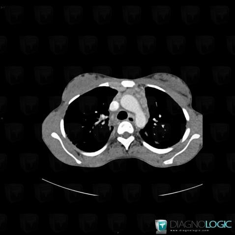 Sarcoidosis, Mediastinum, CT