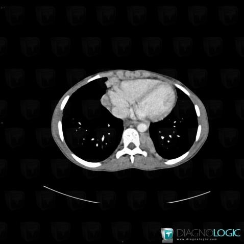 Sarcoidosis, Mediastinum, CT