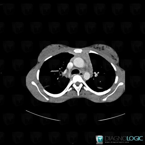 Sarcoidosis, Mediastinum, CT