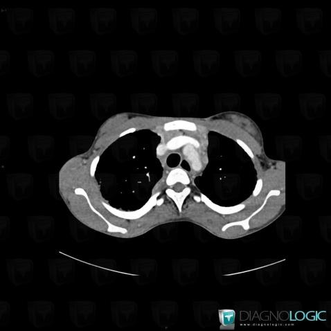 Sarcoidosis, Mediastinum, CT