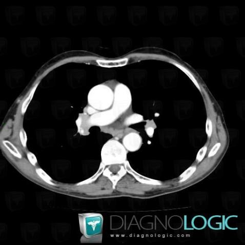 Sarcoidosis, Mediastinum, CT