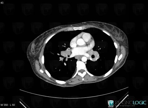 Sarcoidosis, Mediastinum, CT