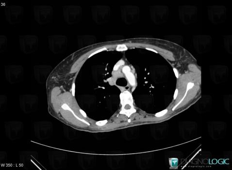 Sarcoidosis, Mediastinum, CT