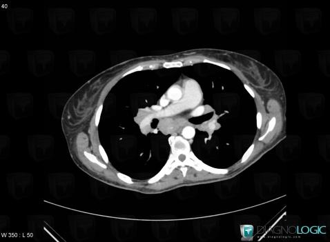 Sarcoidosis, Mediastinum, CT