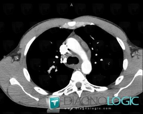 Sarcoidosis, Mediastinum, CT