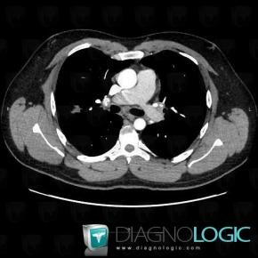 Sarcoidosis, Mediastinum, CT
