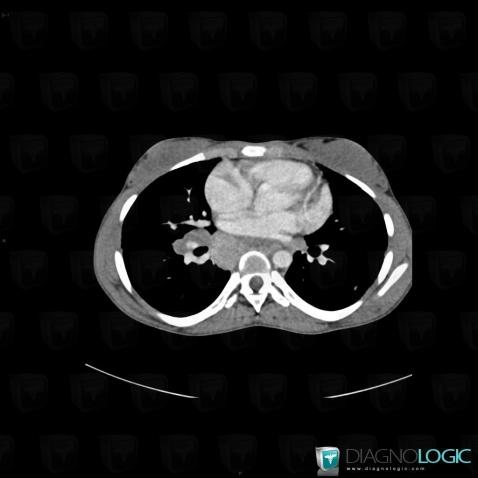 Sarcoidosis, Mediastinum, Paraspinal, CT