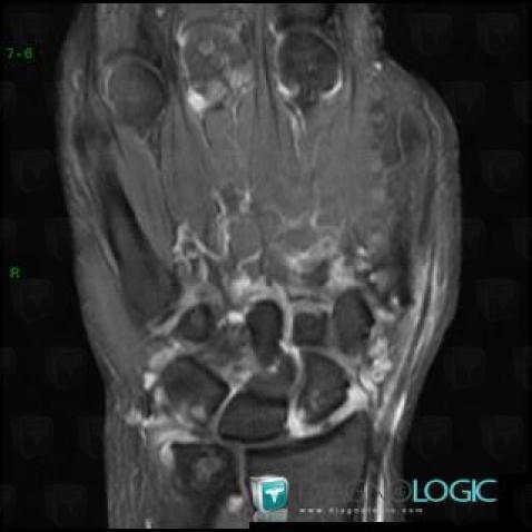 Sarcoidosis, Mediocarpal joint, Radiocarpal joint, MRI