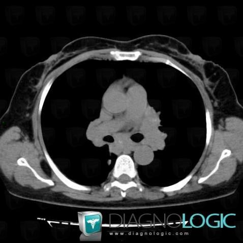 Sarcoidosis, Paraspinal, CT