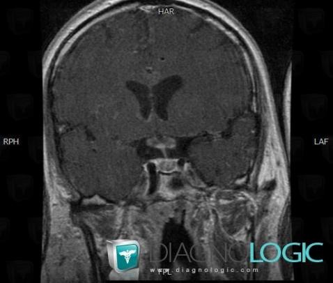 Sarcoidosis, Pituitary gland and parasellar region, MRI