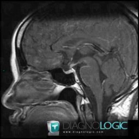 Sarcoidosis, Pituitary gland and parasellar region, MRI