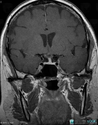 Sarcoidosis, Pituitary gland and parasellar region, MRI