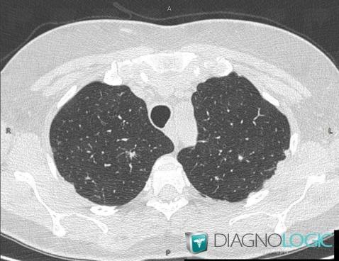 Sarcoidosis, Pleura, CT