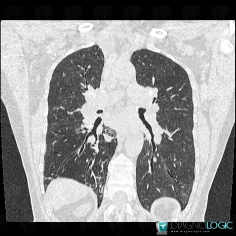 Sarcoidosis, Pulmonary parenchyma, CT