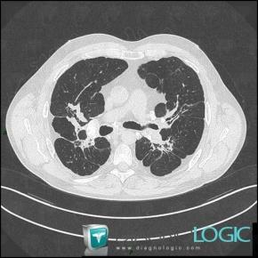 Sarcoidosis, Pulmonary parenchyma, CT