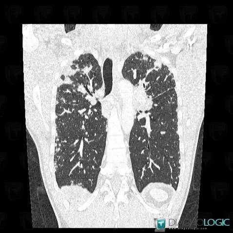 Sarcoidosis, Pulmonary parenchyma, CT