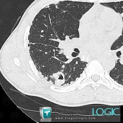 Sarcoidosis, Pulmonary parenchyma, CT