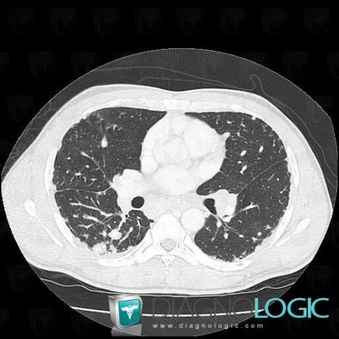 Sarcoidosis, Pulmonary parenchyma, CT