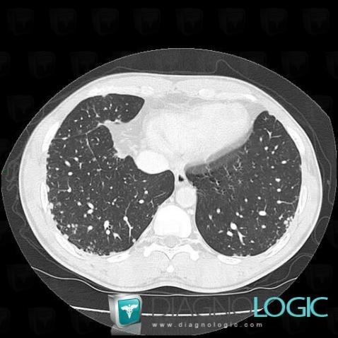 Sarcoidosis, Pulmonary parenchyma, CT