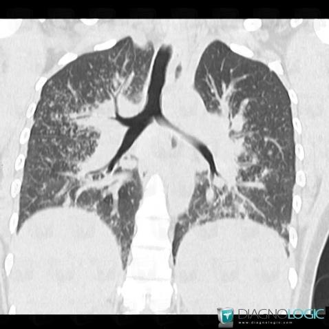 Sarcoidosis, Pulmonary parenchyma, CT