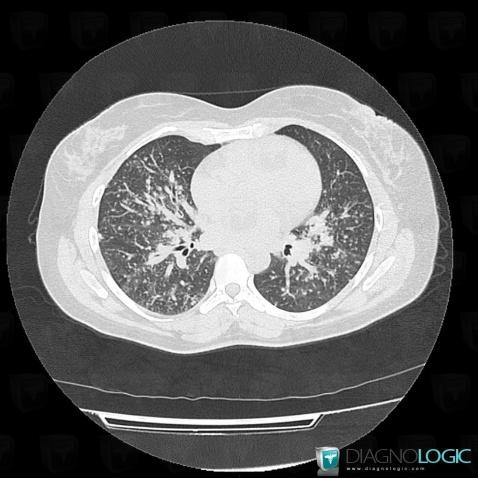 Sarcoidosis, Pulmonary parenchyma, CT