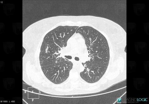 Sarcoidosis, Pulmonary parenchyma, CT