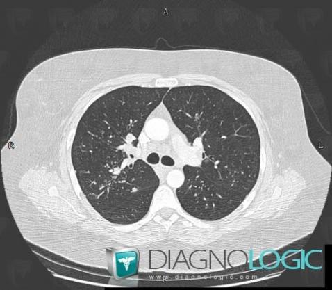 Sarcoidosis, Pulmonary parenchyma, CT