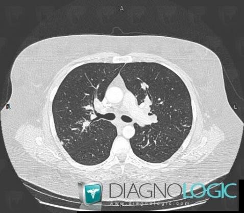 Sarcoidosis, Pulmonary parenchyma, CT