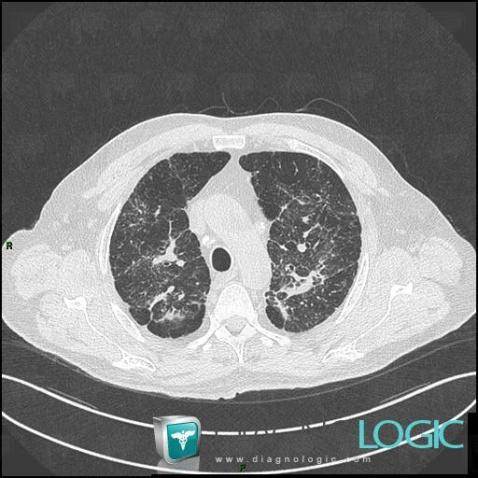 Sarcoidosis, Pulmonary parenchyma, CT