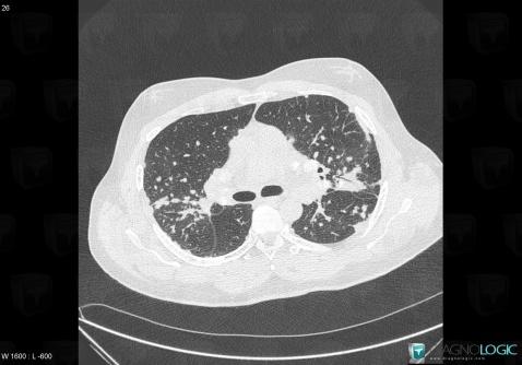 Sarcoidosis, Pulmonary parenchyma, CT