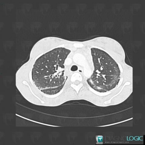 Sarcoidosis, Pulmonary parenchyma, CT