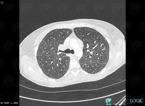 Sarcoidosis, Pulmonary parenchyma, CT