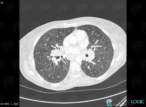 Sarcoidosis, Pulmonary parenchyma, CT