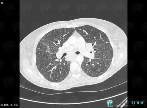 Sarcoidosis, Pulmonary parenchyma, CT