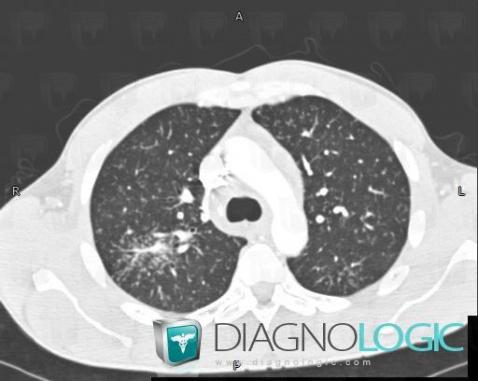 Sarcoidosis, Pulmonary parenchyma, CT