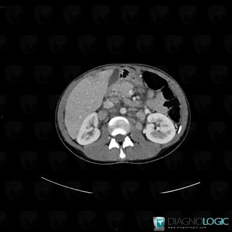 Sarcoidosis, Retroperitoneum, CT