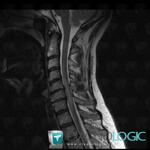 Sarcoidosis, Spinal canal / Cord, MRI