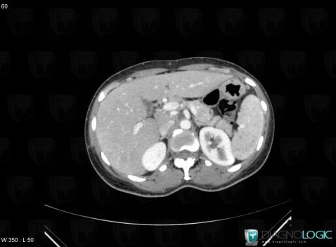 Sarcoidosis, Spleen, CT