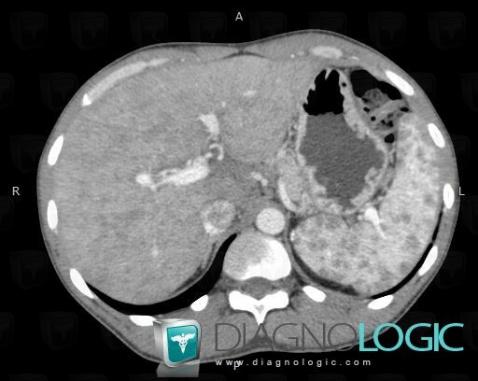 Sarcoidosis, Spleen, CT