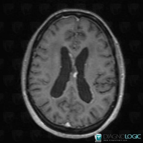 Sarcoidosis, Supratentorial peri cerebral spaces, MRI